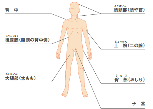 悪性軟部腫瘍 - その他