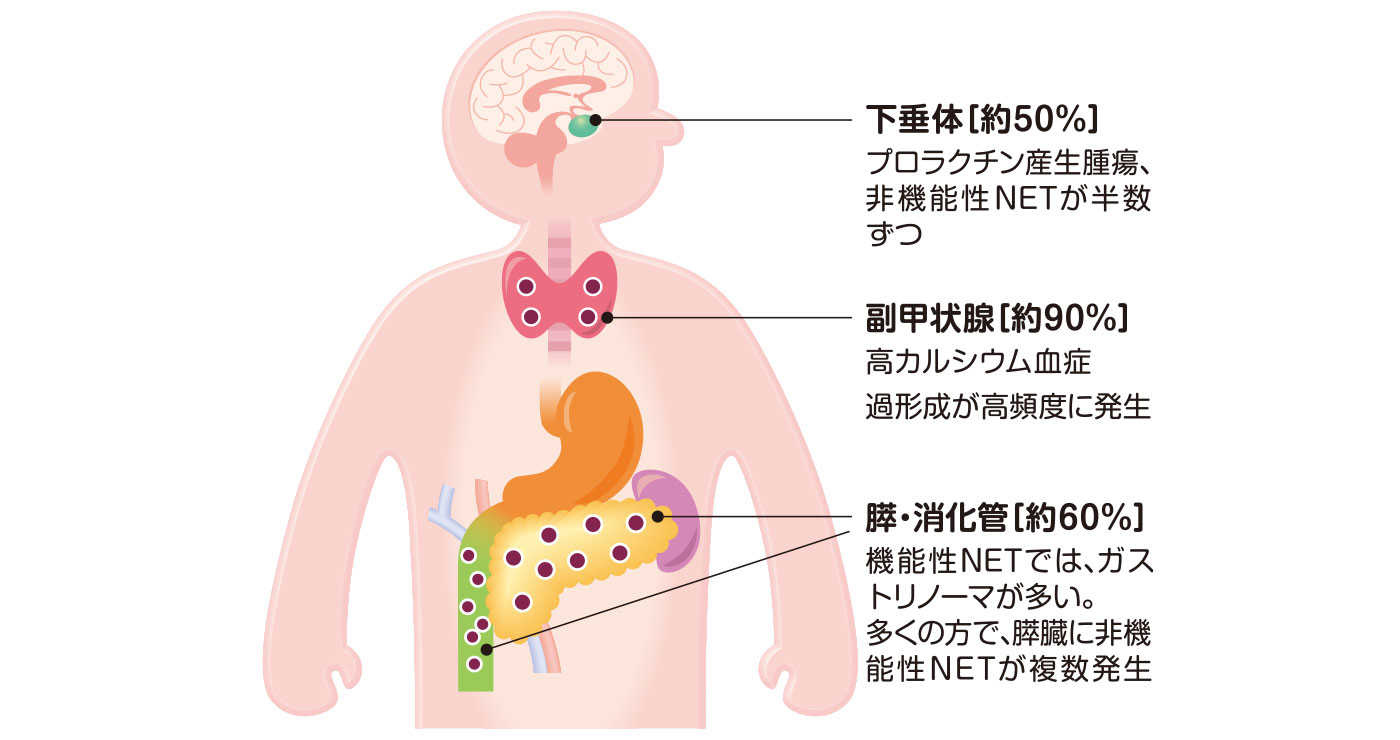 家族性腫瘍（遺伝性腫瘍症候群）の分類 | NET Links（神経内分泌腫瘍.net） | がんと希少な病気の情報サイト | ノバルティス  ファーマ株式会社